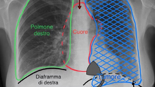 Innovativo intervento chirurgico con il posizionatore cardiaco eseguito all’ospedale Molinette